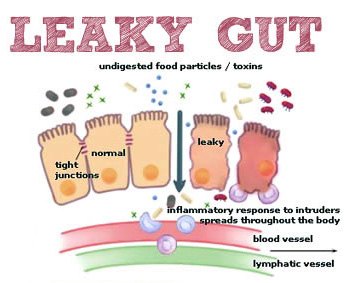 Leaky Gut