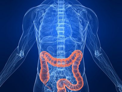 Colorectal Cancer